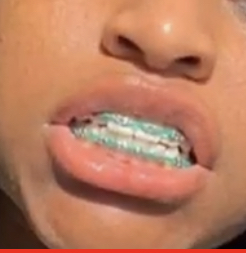 I want to have braces before 8th grade