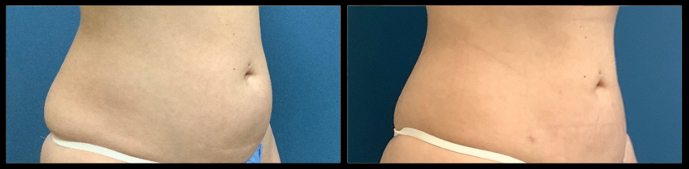 before and afters toned tummy