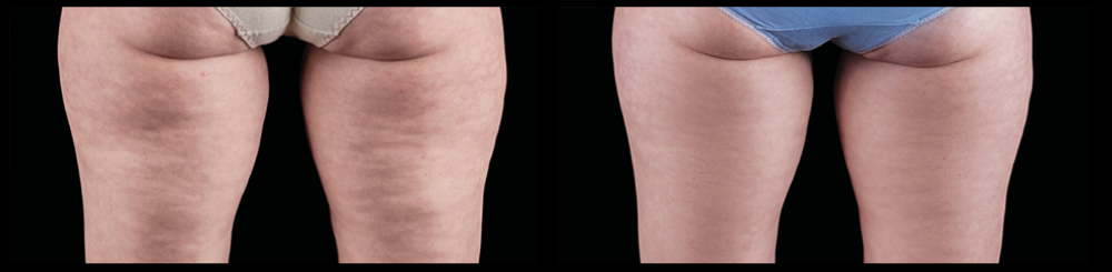 reduced cellulite before and afters