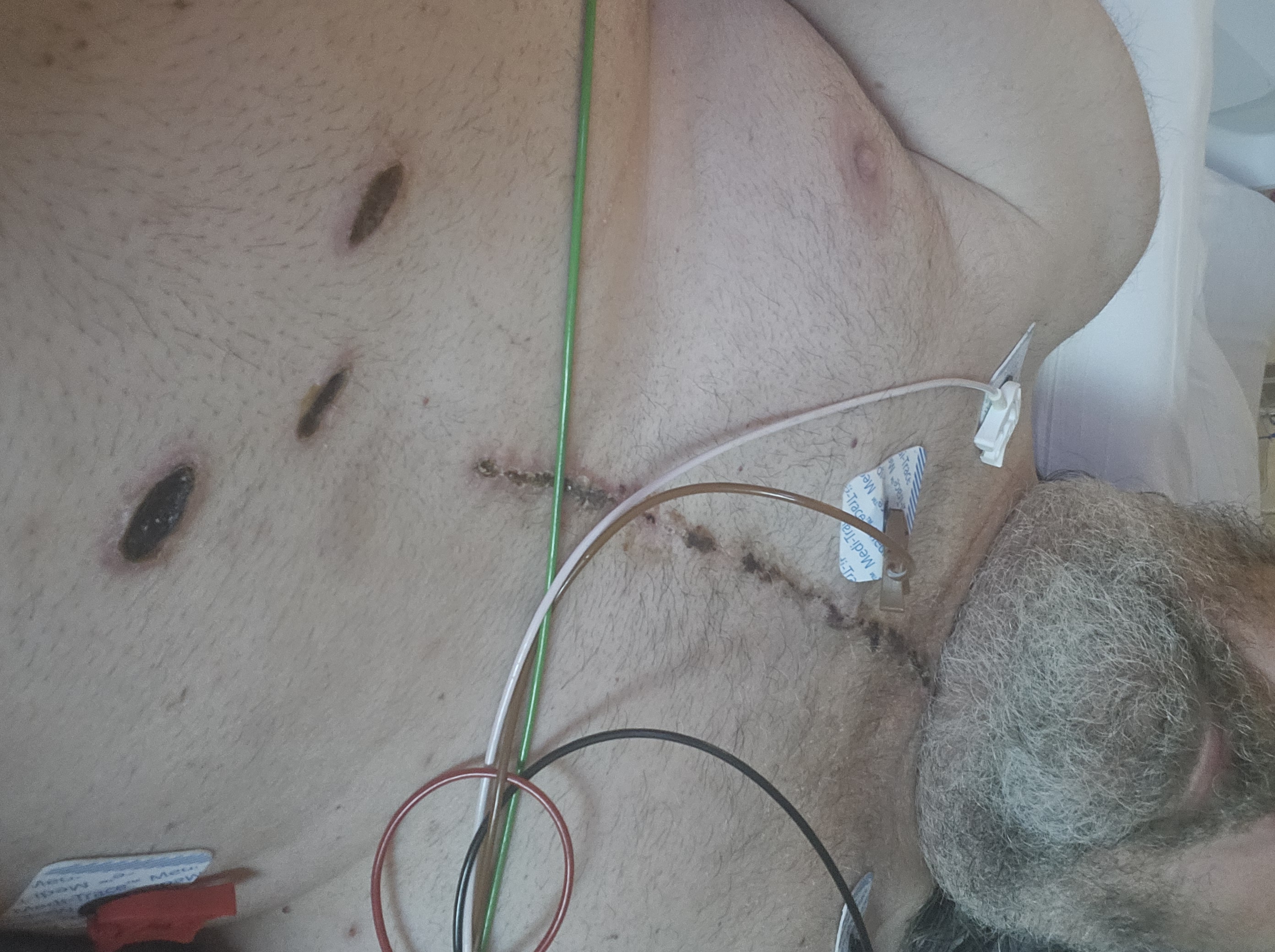 Heart surgery