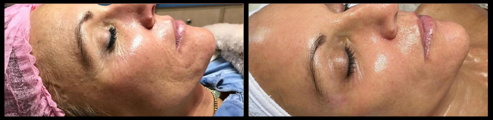 before and afters toned tummy