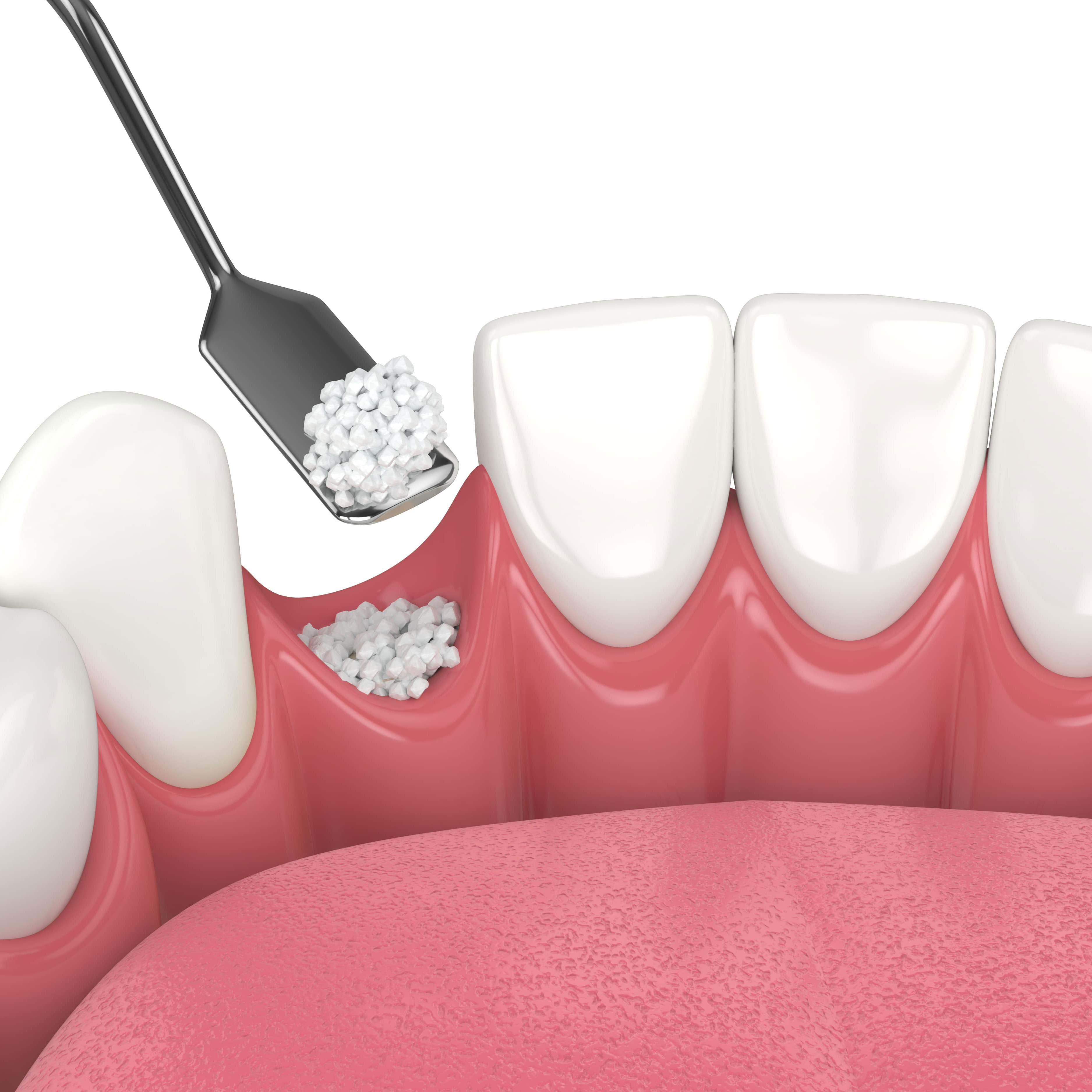 bone grafting & ridge expansion