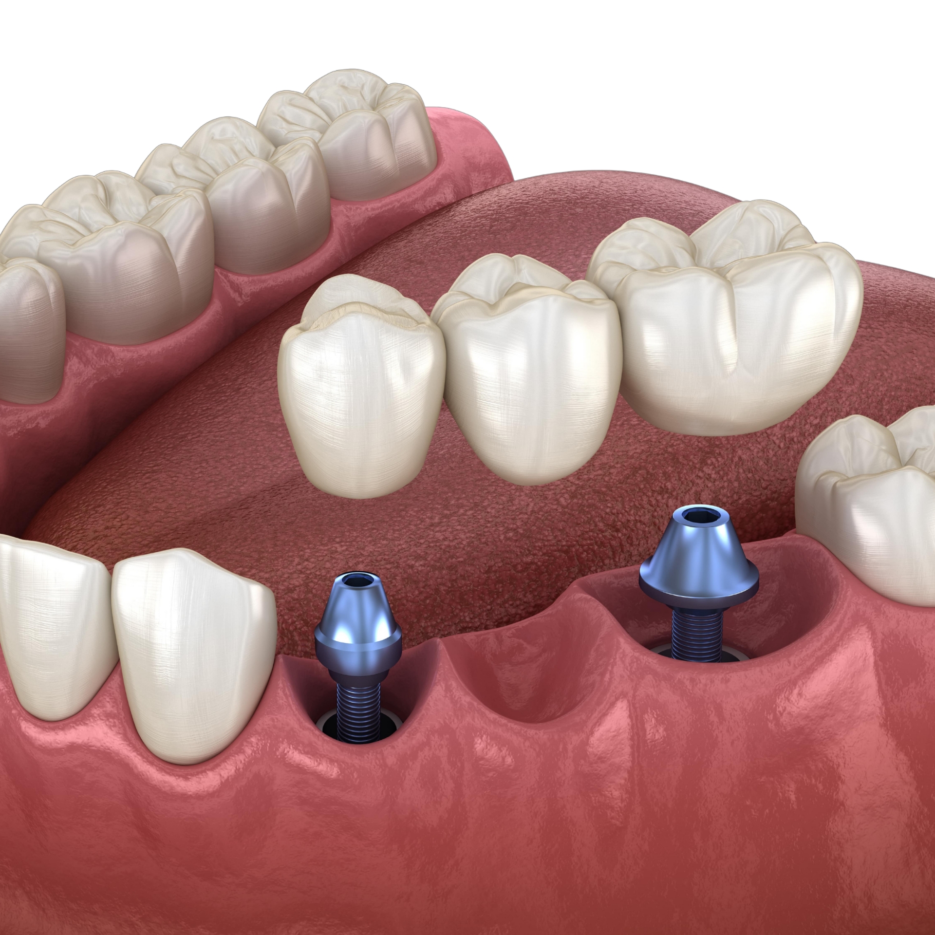implant retained partials & bridges