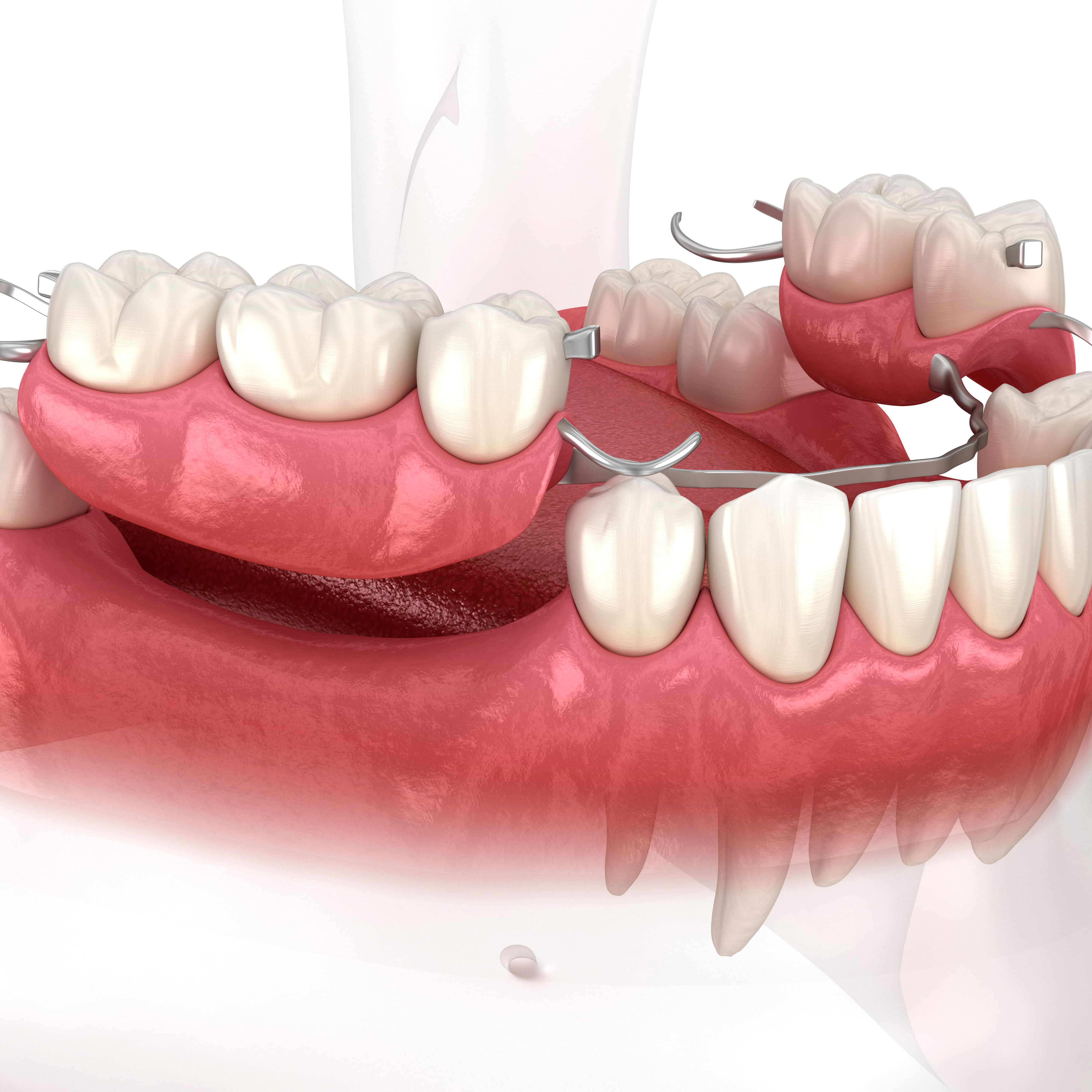 partials & dentures