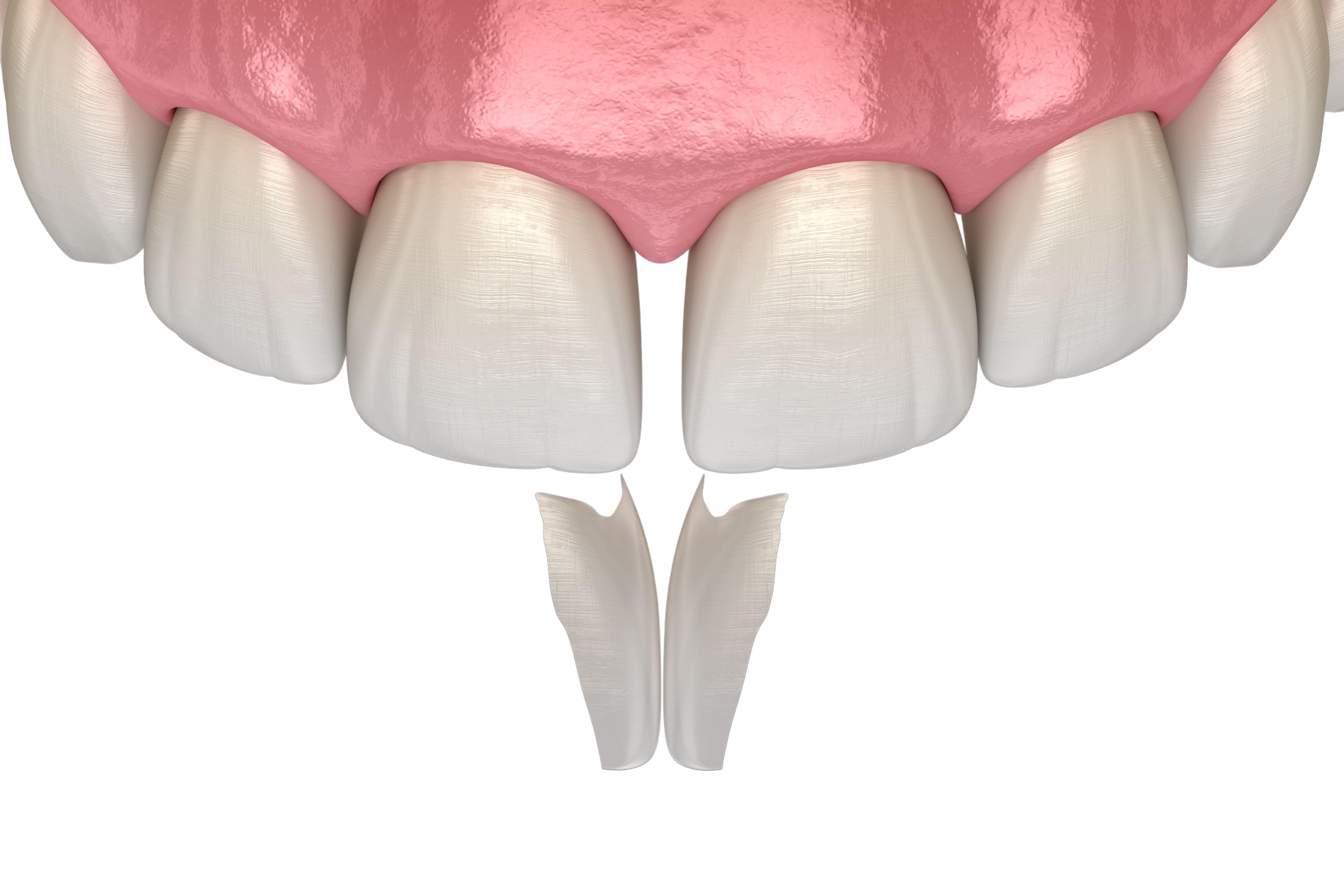 Tooth Recontouring