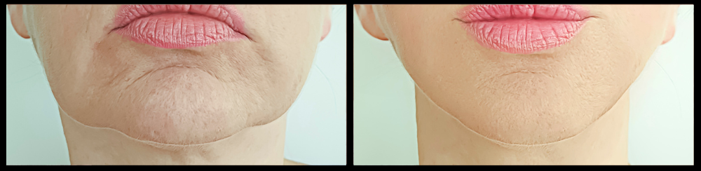 reduced cellulite before and afters