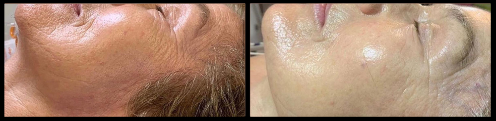 reduced cellulite before and afters