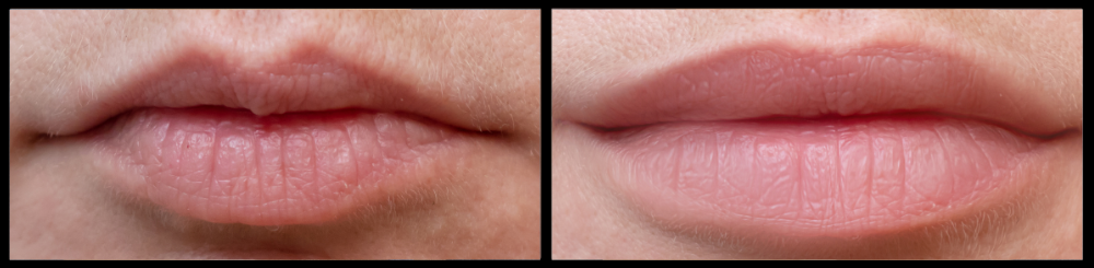 before and afters toned tummy