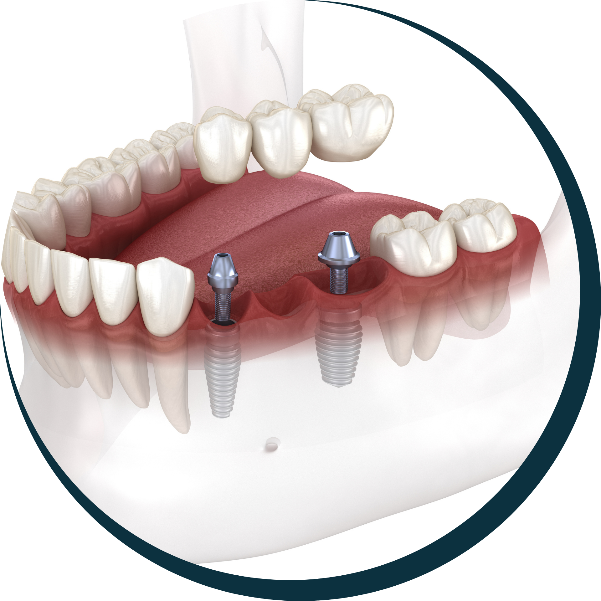 Dental Bridges