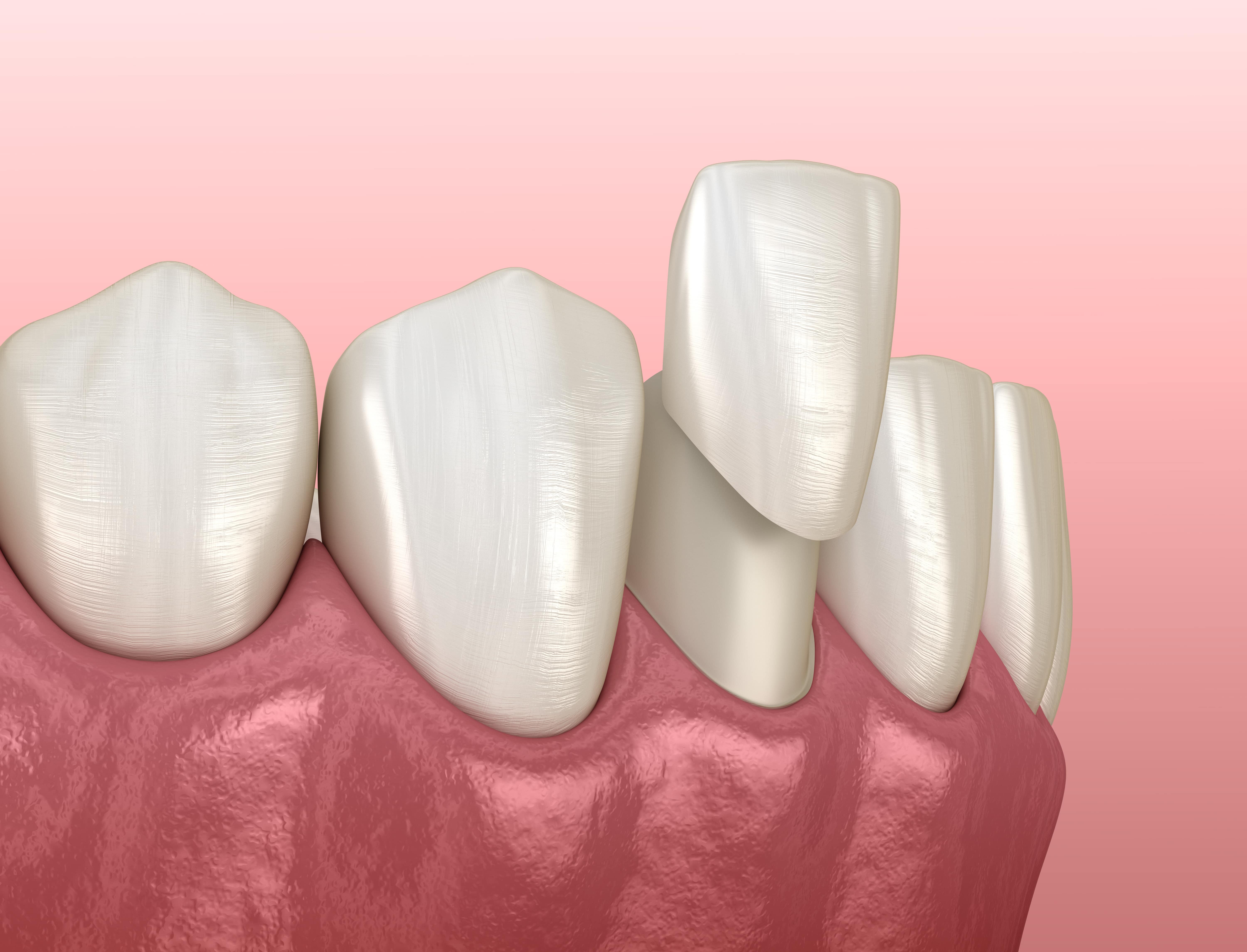 Porcelain Veneers