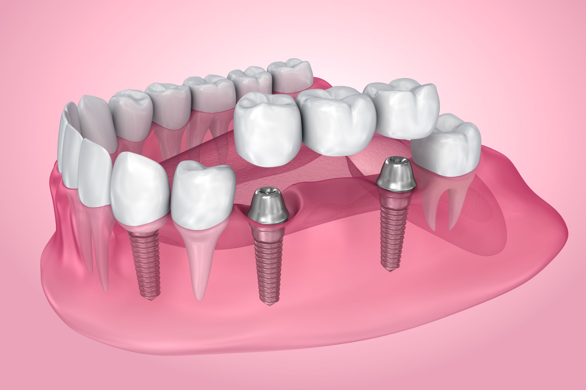 Dental Implants vs. Dentures