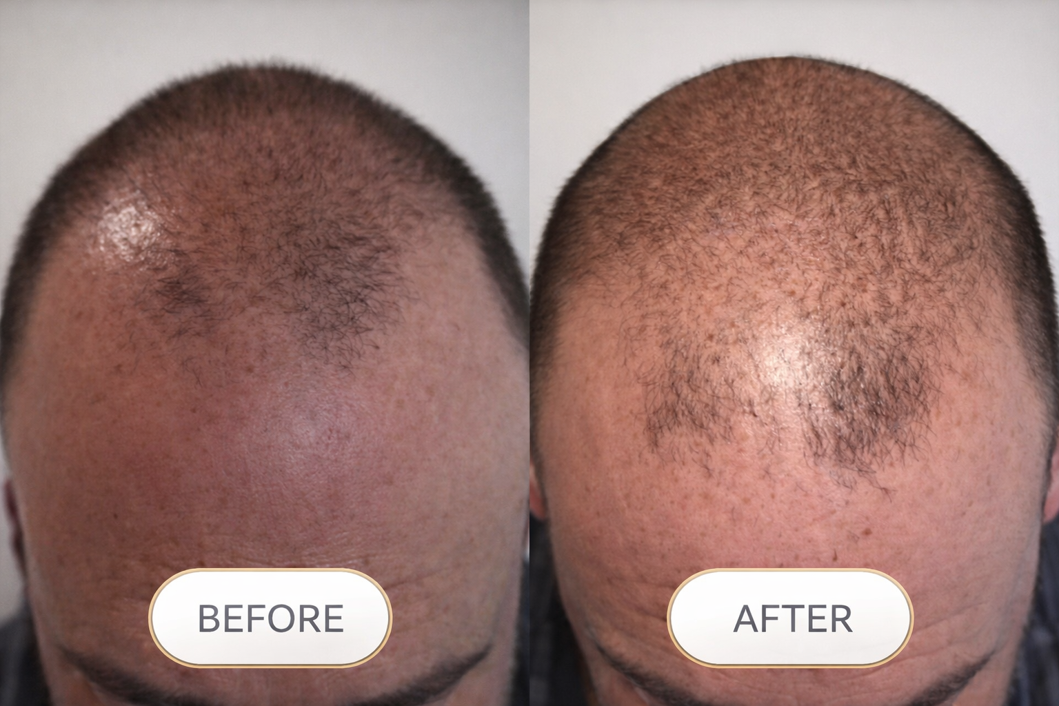 LED Cap & RootVital Hair Growth Bundle - Image 3