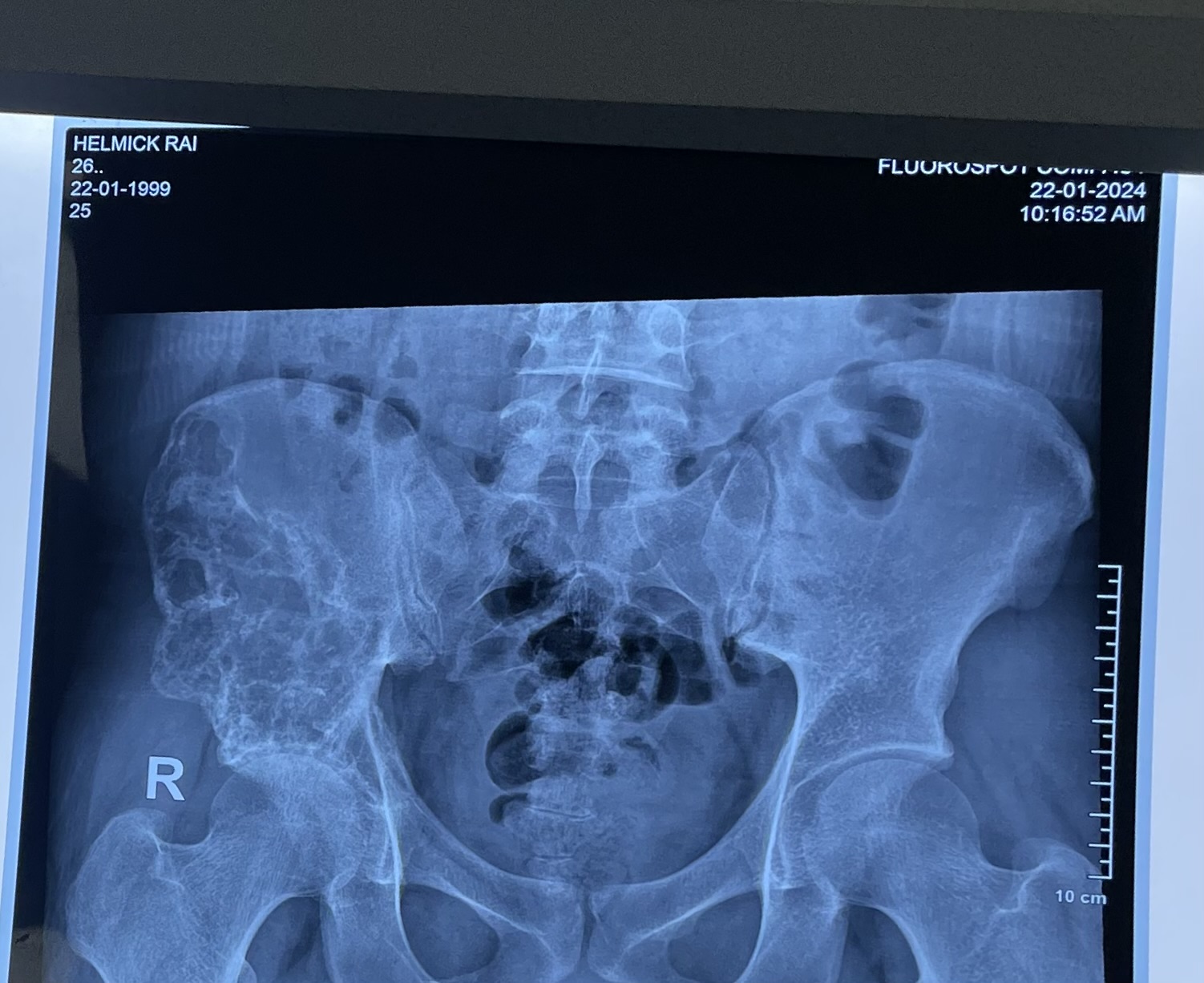 I have cancer on pelvis bone help ((