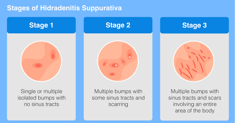 Hidradenitis suppurativa