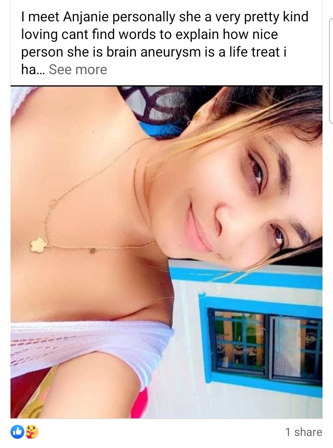 Brain Surgery For Saccular Aneurysm