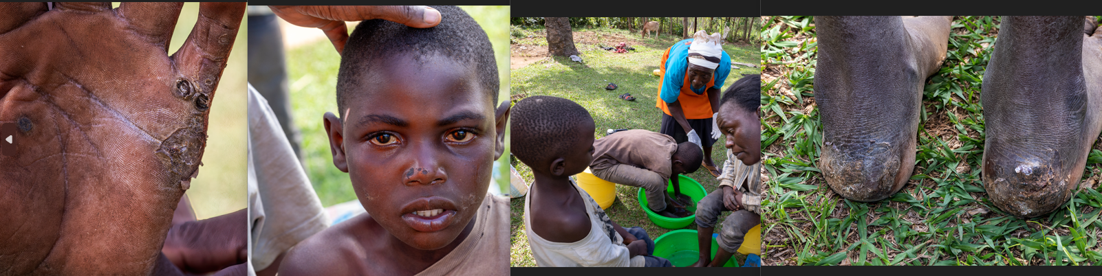 Increase the school going children by Kicking Jiggers out of Butere