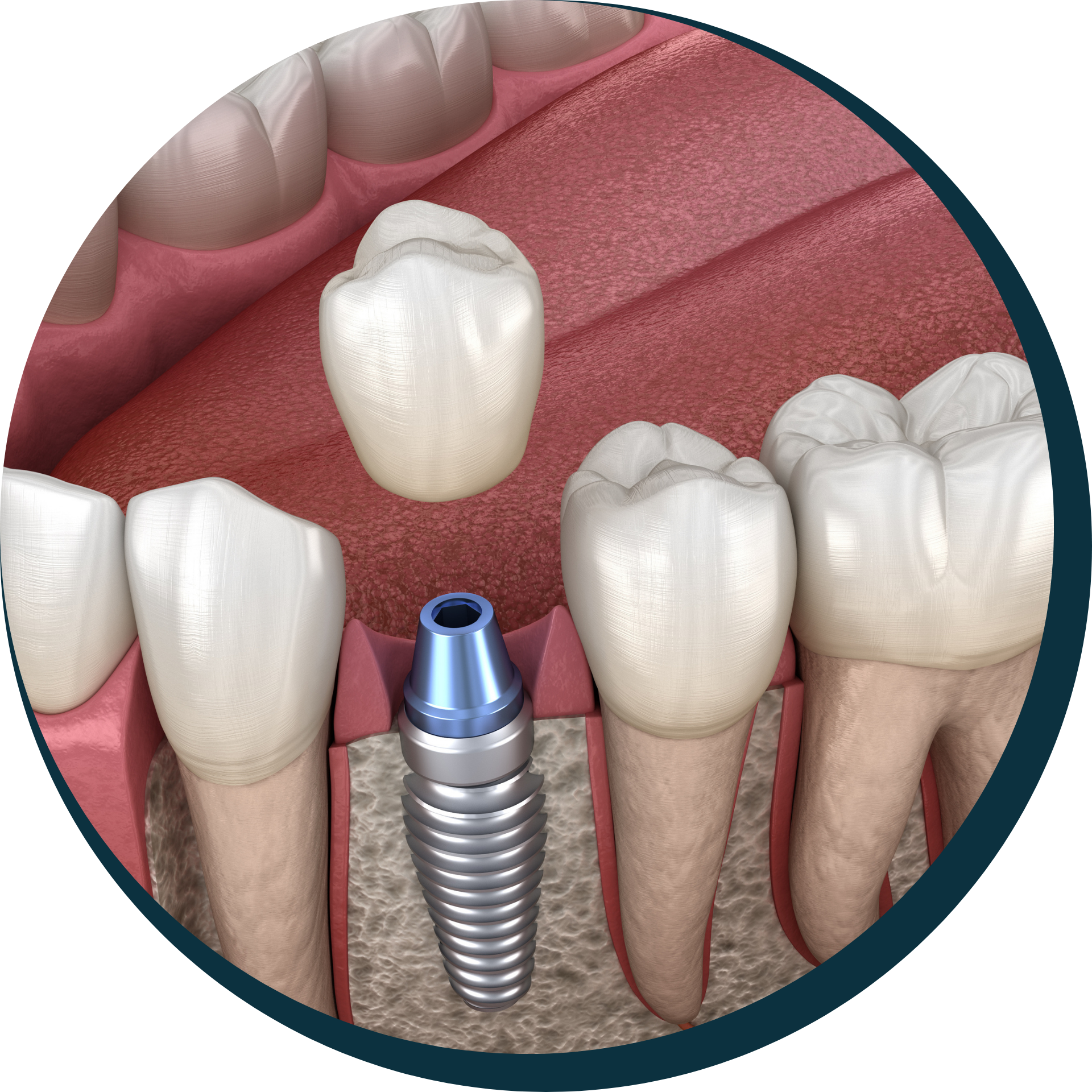 Single Tooth Implants