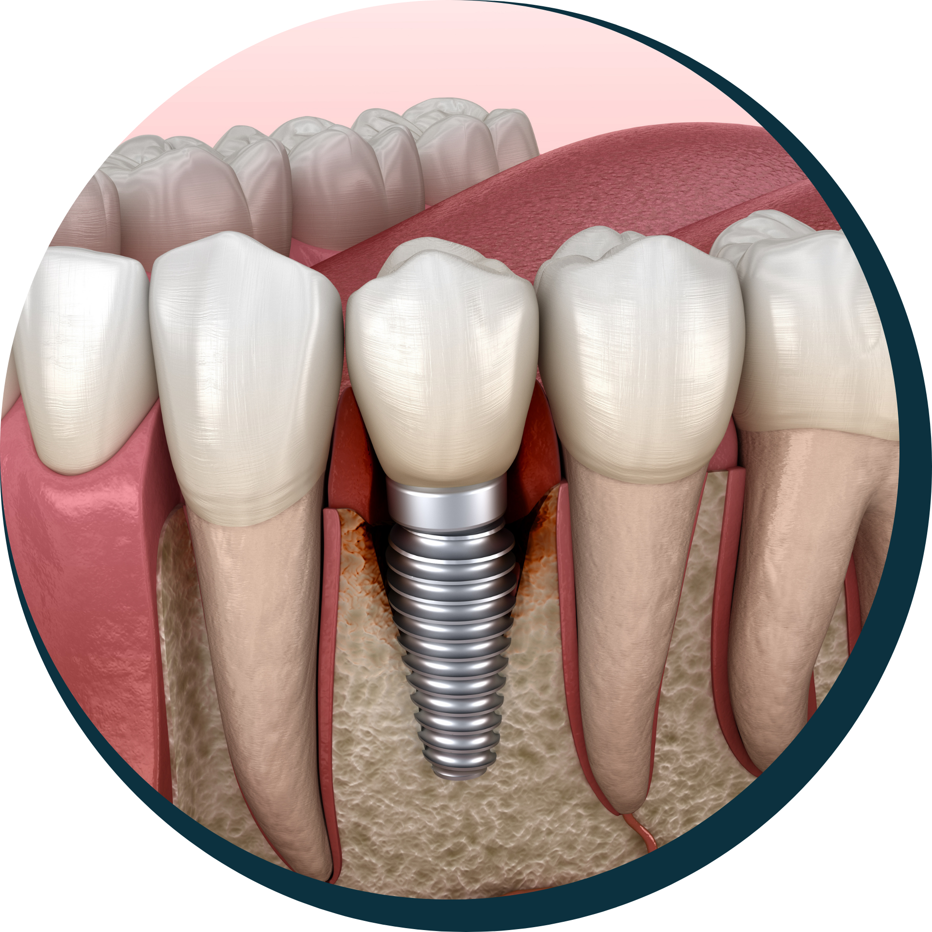 Implant Repair & Replacement