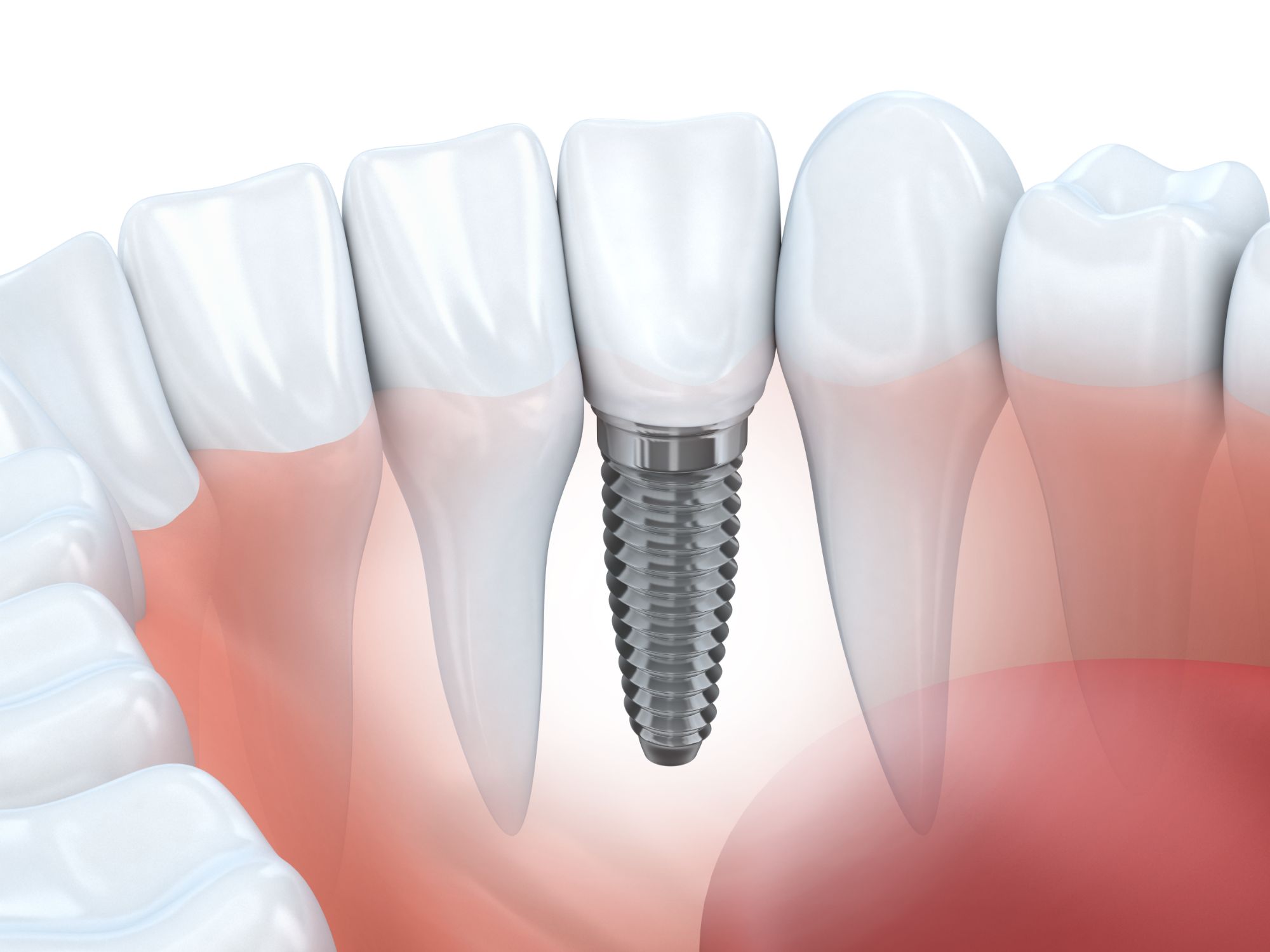 Dental Implant Repair & Replacement