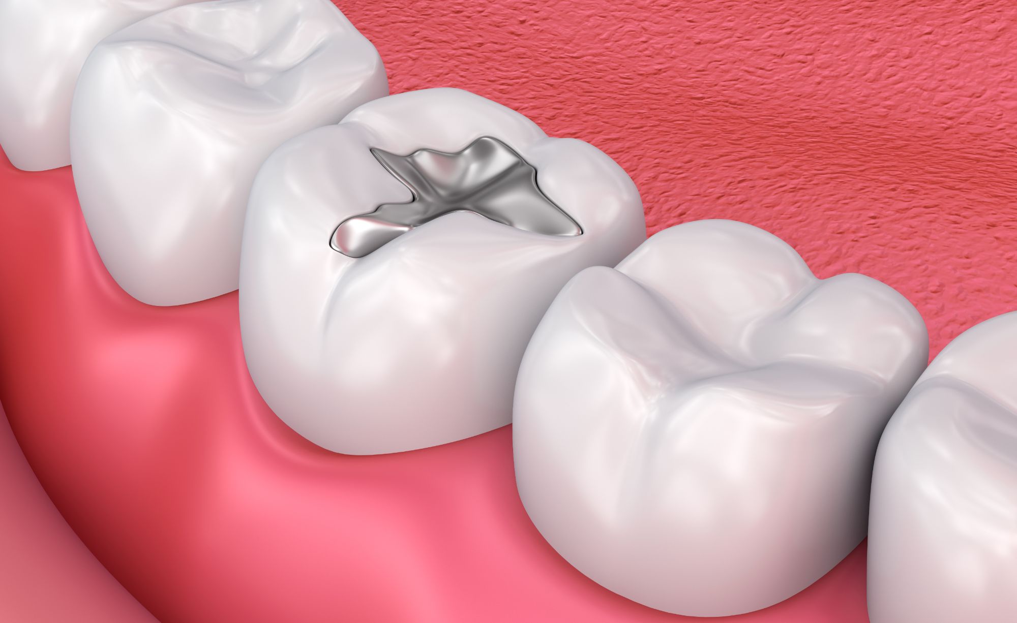 Composite Fillings