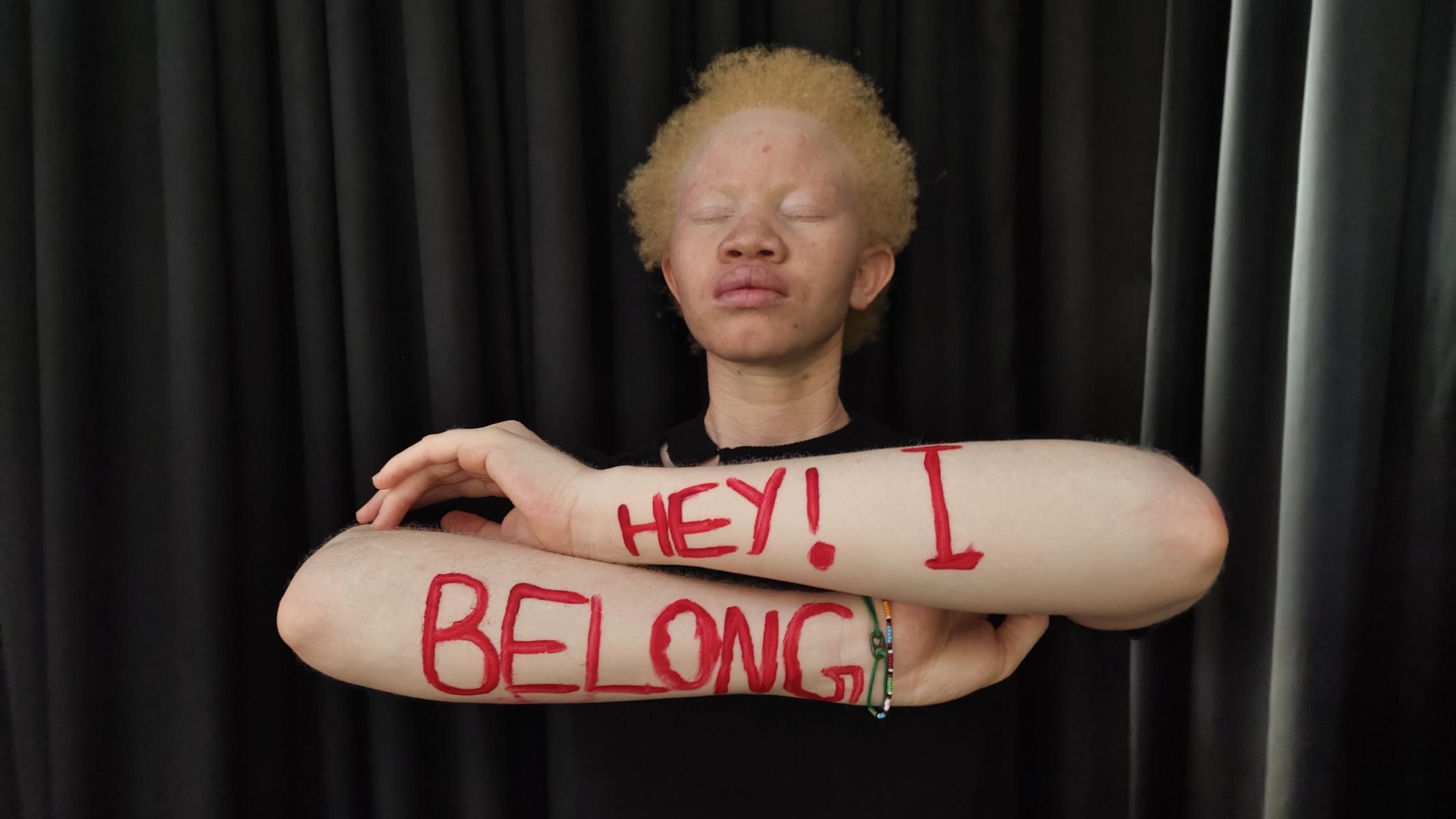 Project Halisi: Empower persons with albinism who have faced atrocities and discrimination with skills to enable them to self-integrate into society