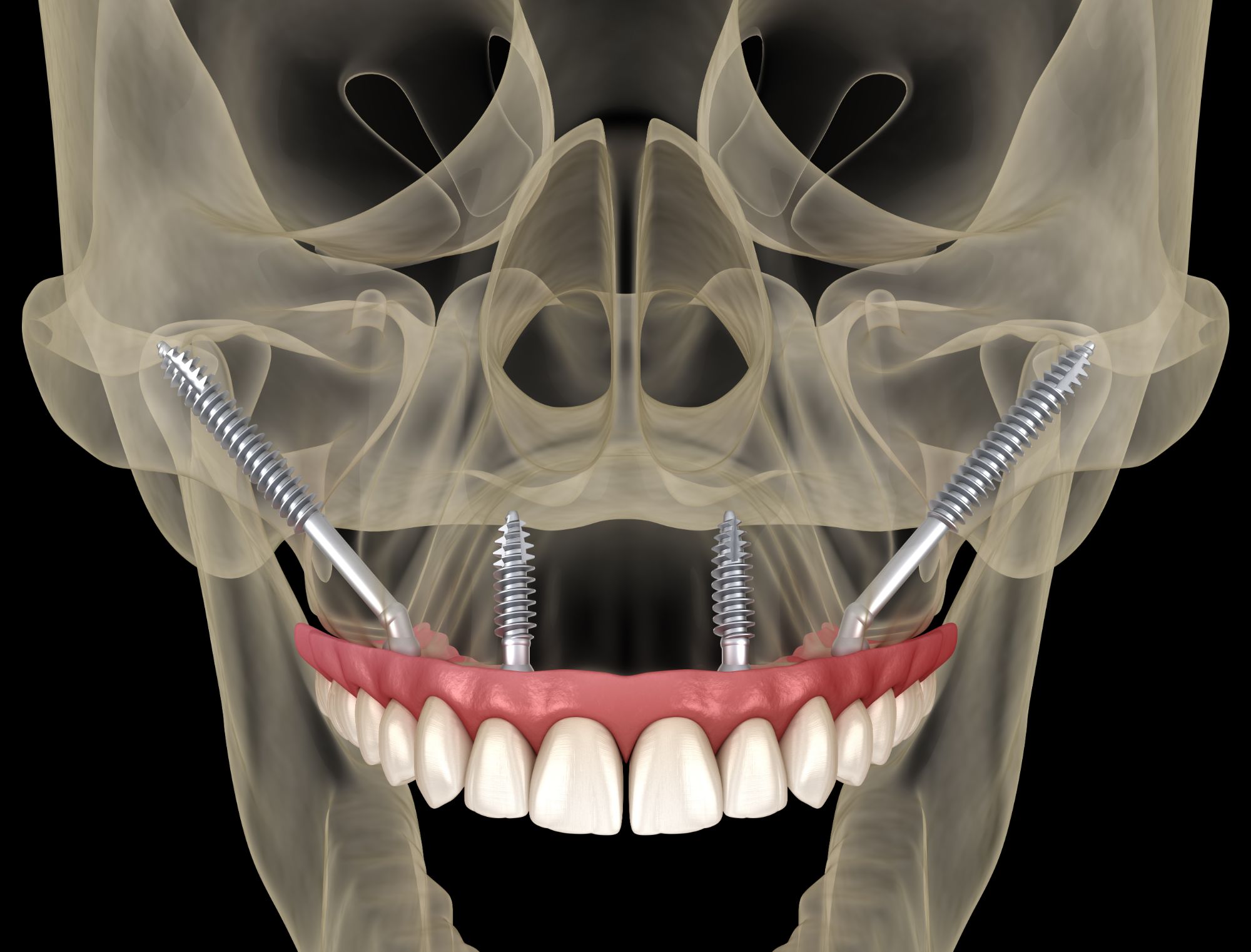 Dentures vs Dental Implants