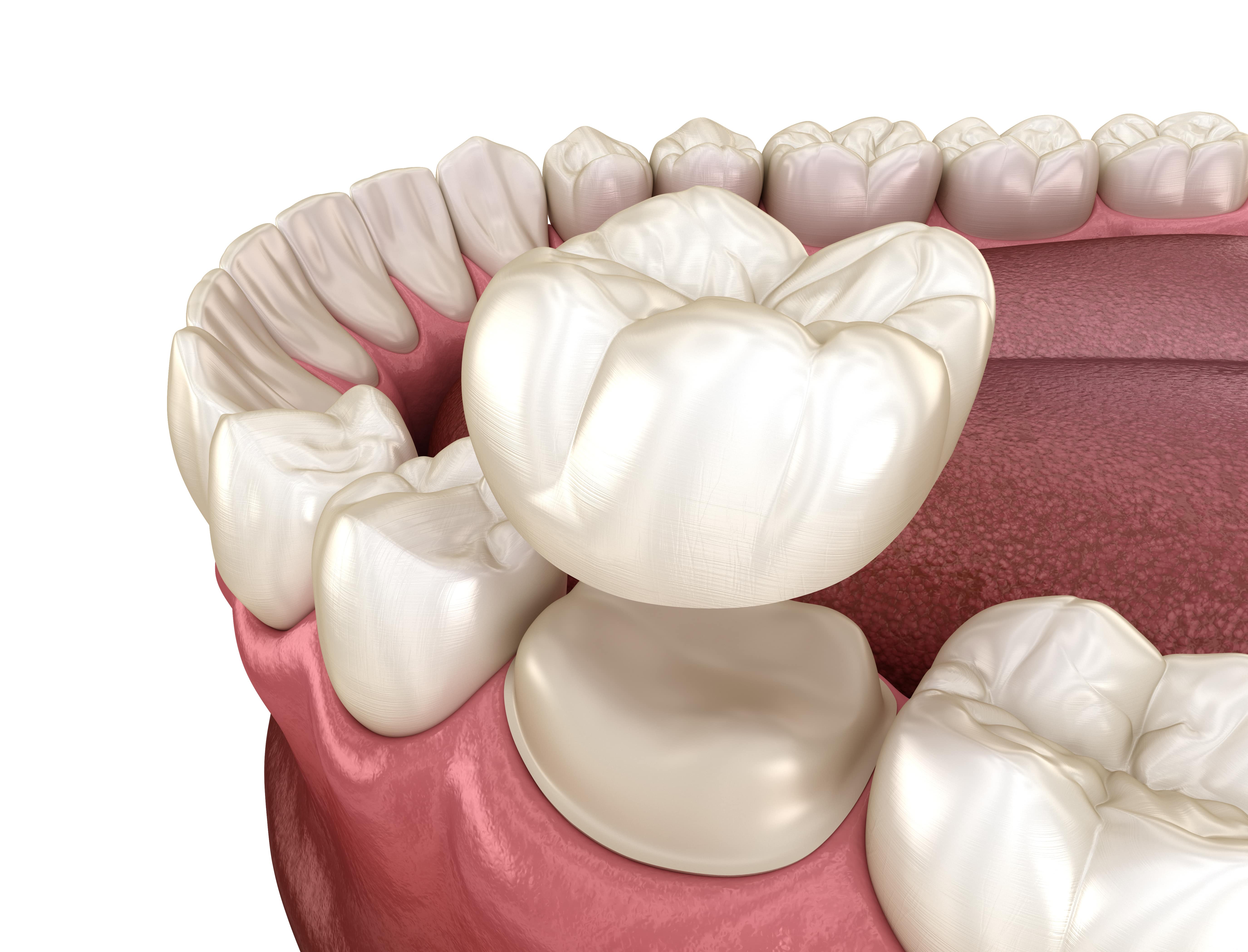 Dental Crowns