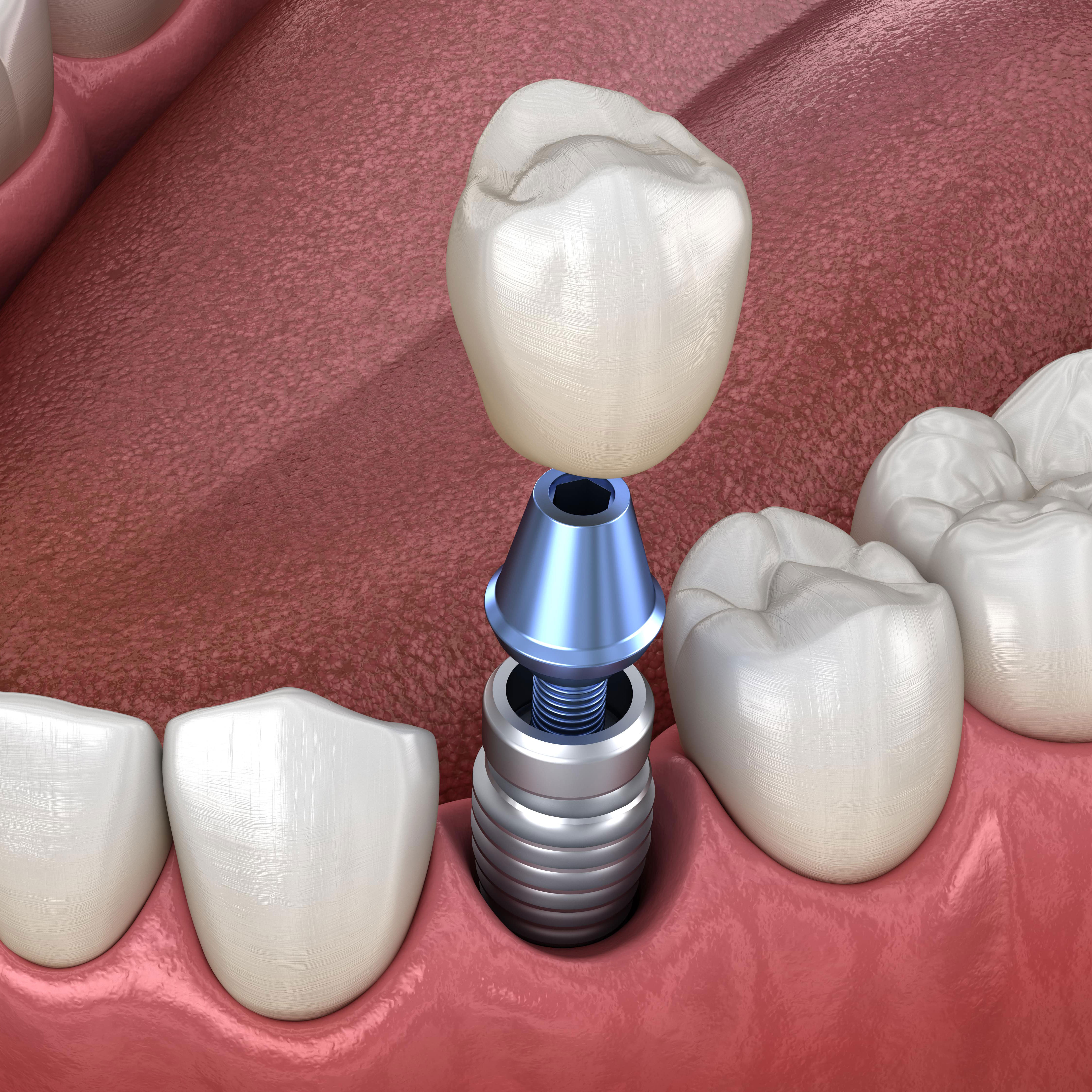 single tooth implants