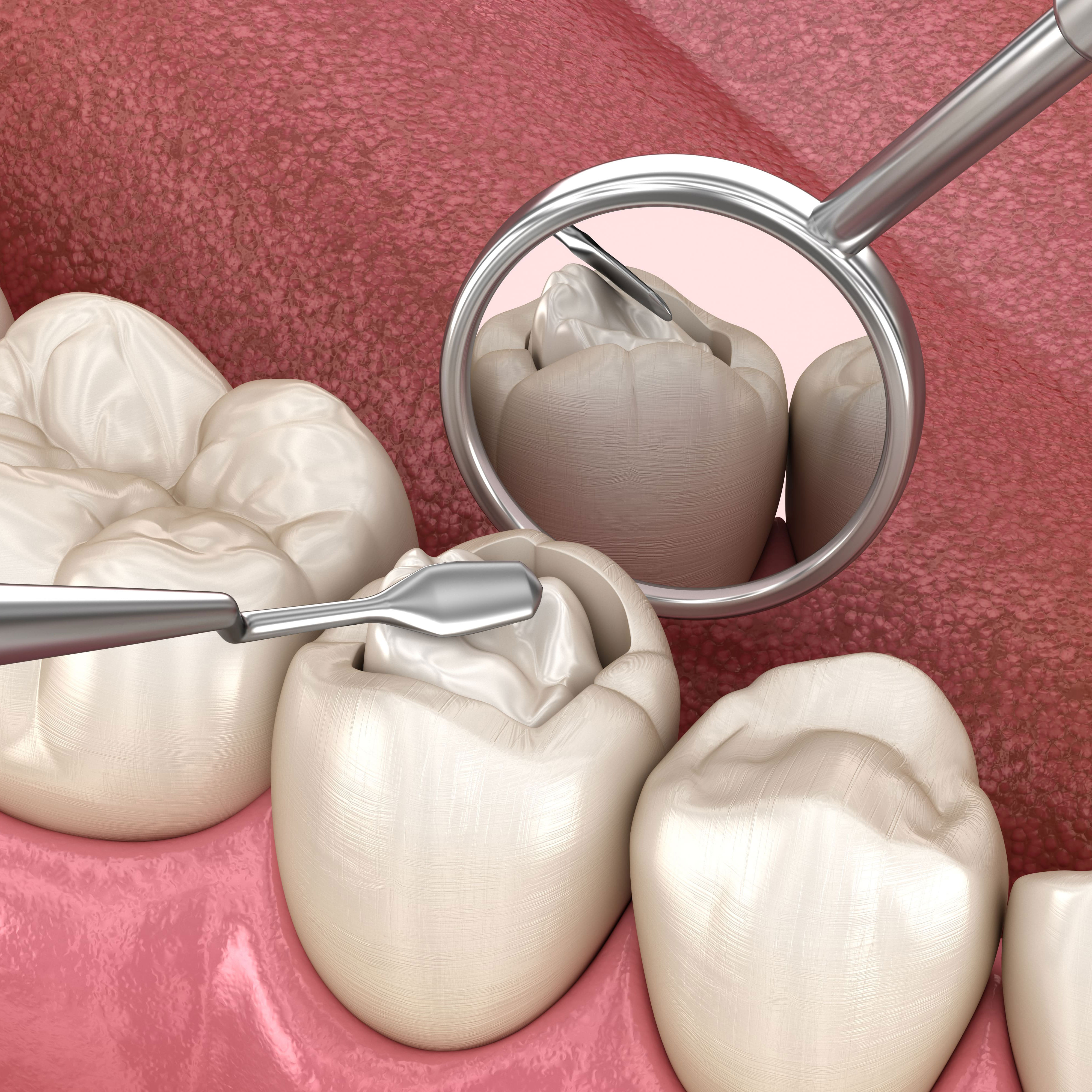 composite fillings