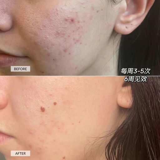 【瑕疵皮福音】Currentbody，最新红蓝光面膜仪，上架+9折！