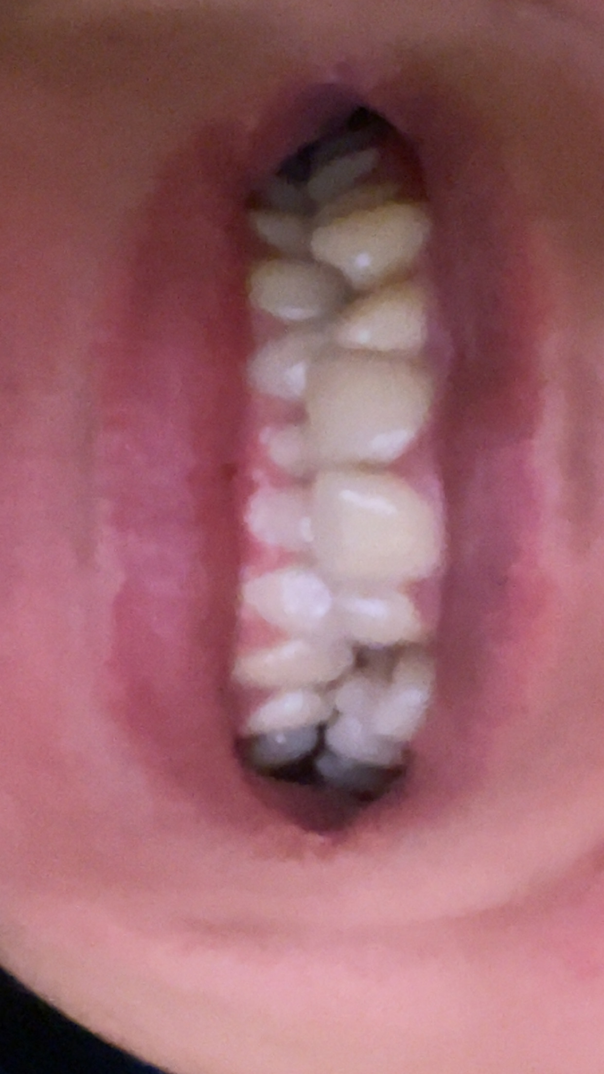 Seeking Help for Braces &ndash; Struggling with Self-Esteem and No Family Support