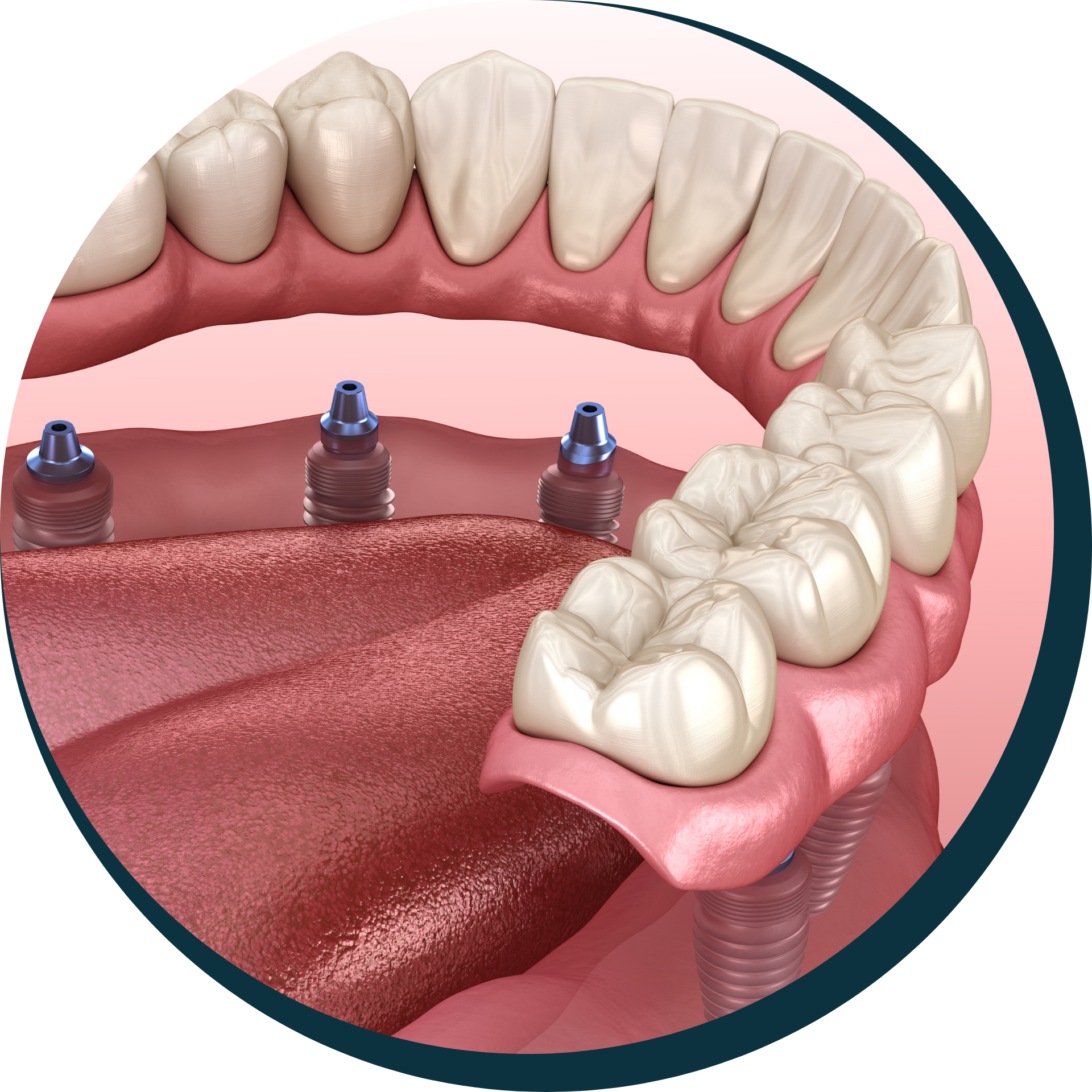 Implant-Supported Dentures
