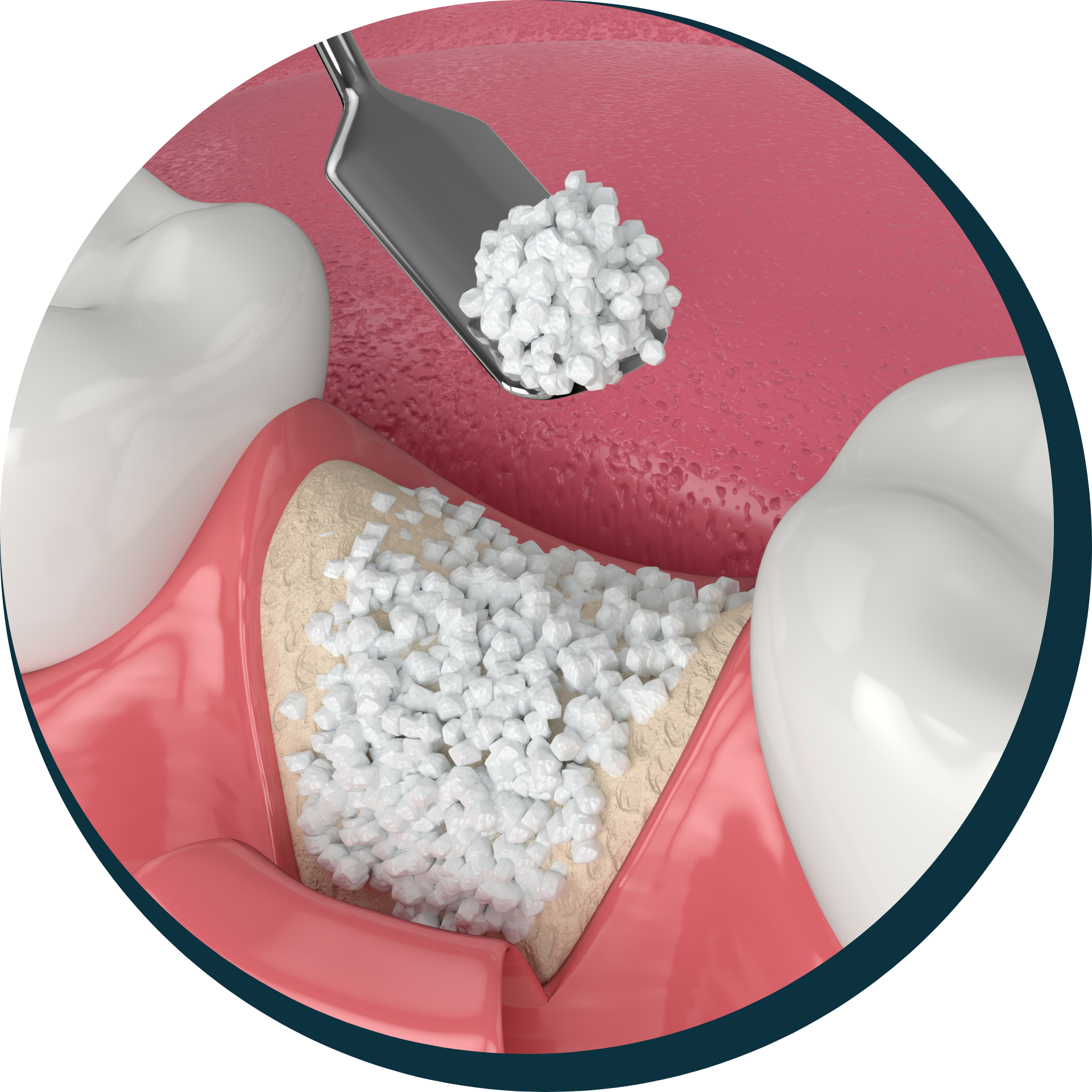 Bone Grafting