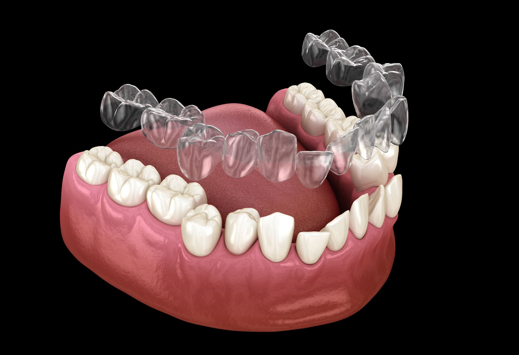 ClearCorrect®