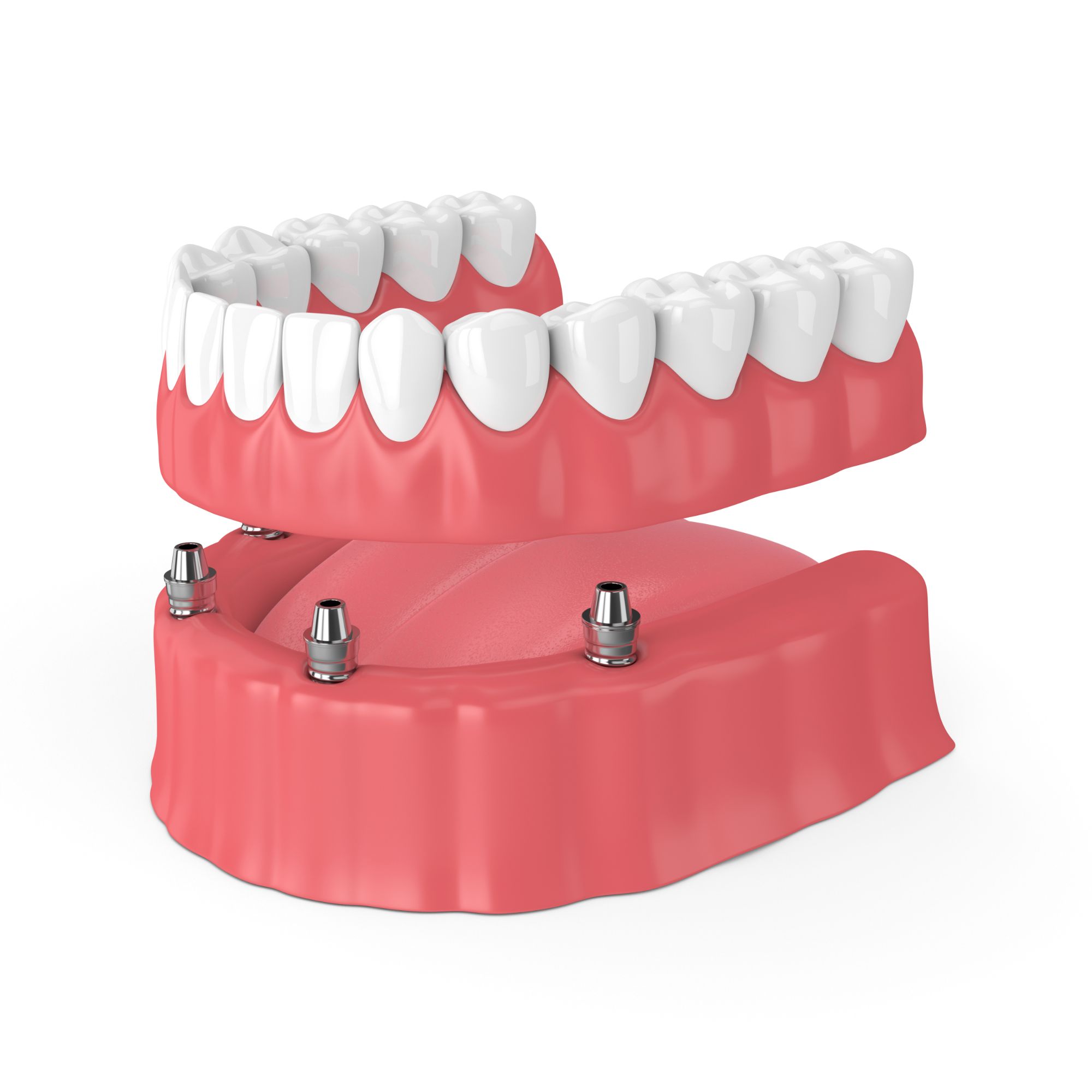 Full Mouth Implants