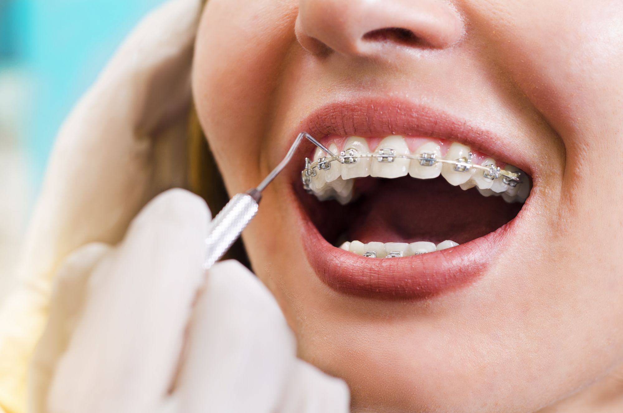 Fast Braces