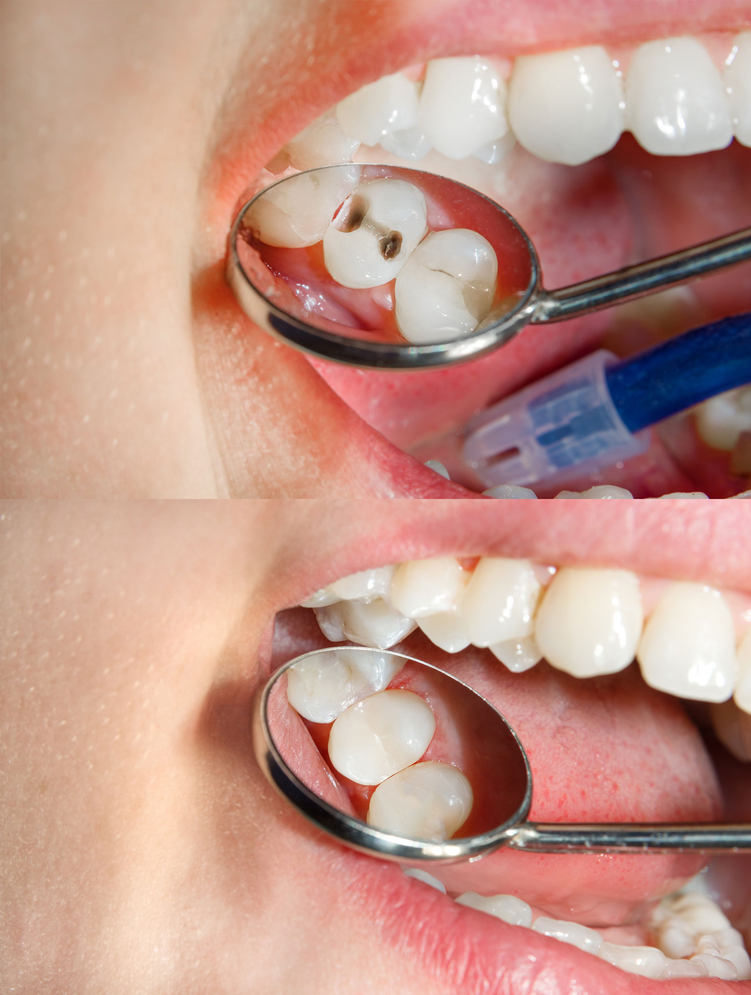 Cosmetic Fillings