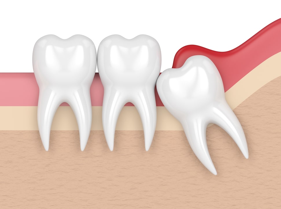 Wisdom Tooth Removal